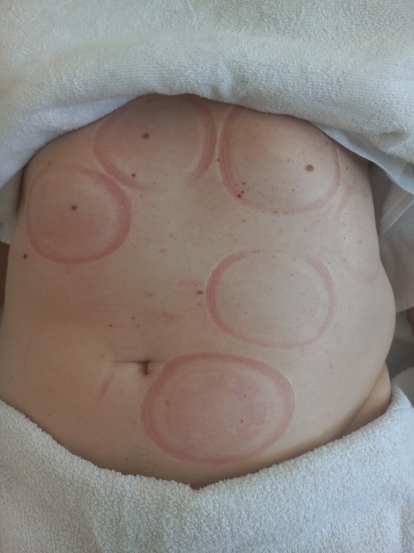 Das Bild zeigt überwiegend hellrote Ringe mit einem blassen bis leicht rosa Zentrum.Flecken nach dem Schröpfentherapie