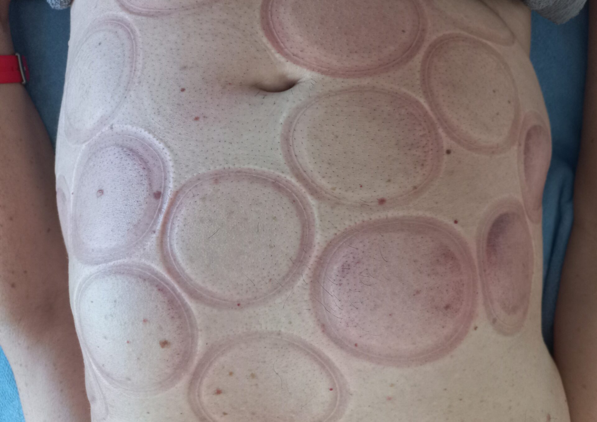 Dieses Bild zeigt kreisrunde, hellrote bis rötliche Ringe und Male auf der Haut im Bauchbereich