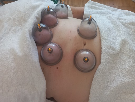 Dieses Bild zeigt Schröpfgläser auf dem Bauch