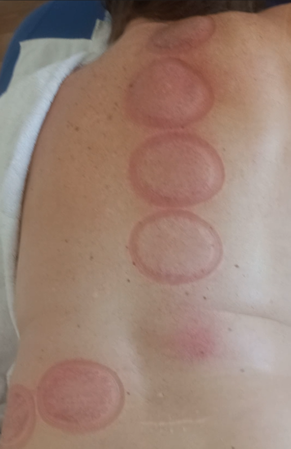Dieses Bild zeigt die Hautreaktion auf dem Rücken derselben Person direkt nach dem Entfernen der Schröpfgläser.