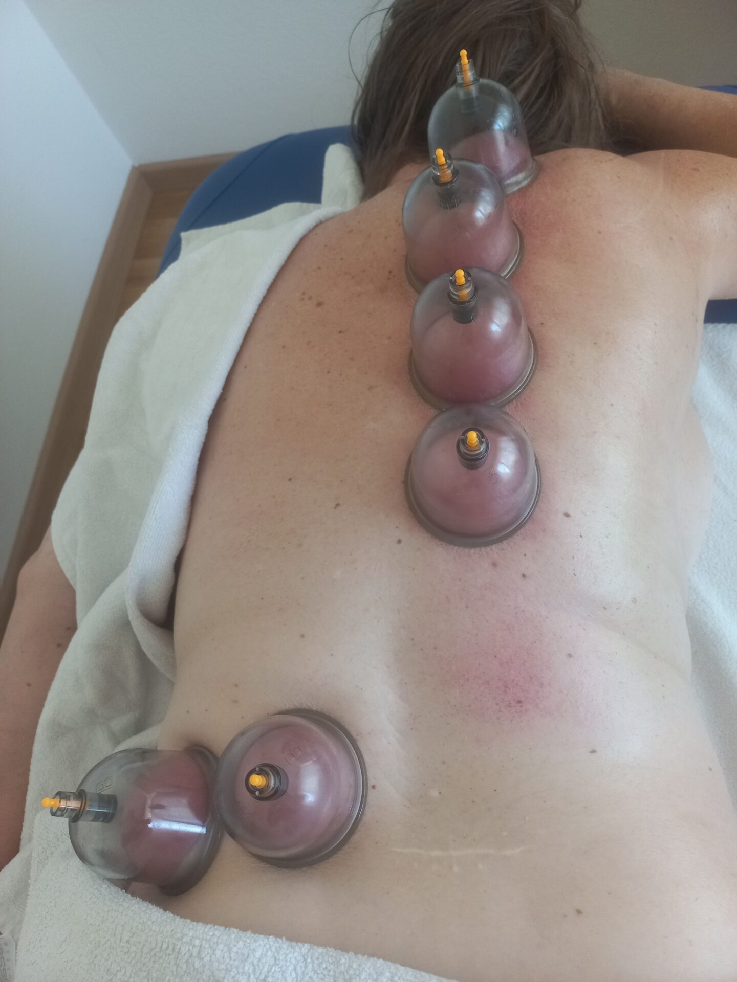 Das Bild zeigt eine Person, die sich einer Schröpftherapie (Cupping) am Rücken wegen Skoliose unterzieht
