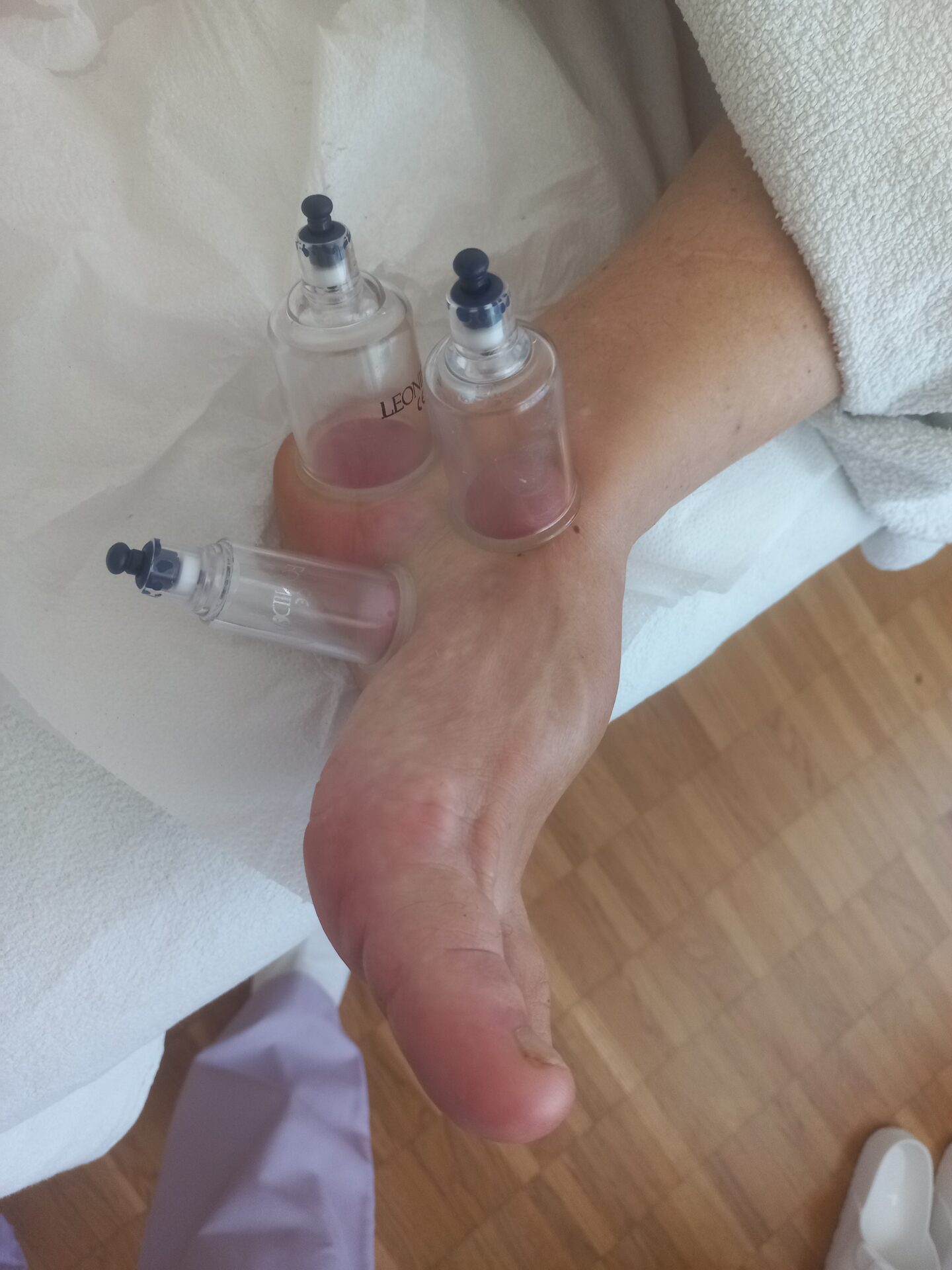 Dieses Bild zeigt Schröpfgläser am Fuss