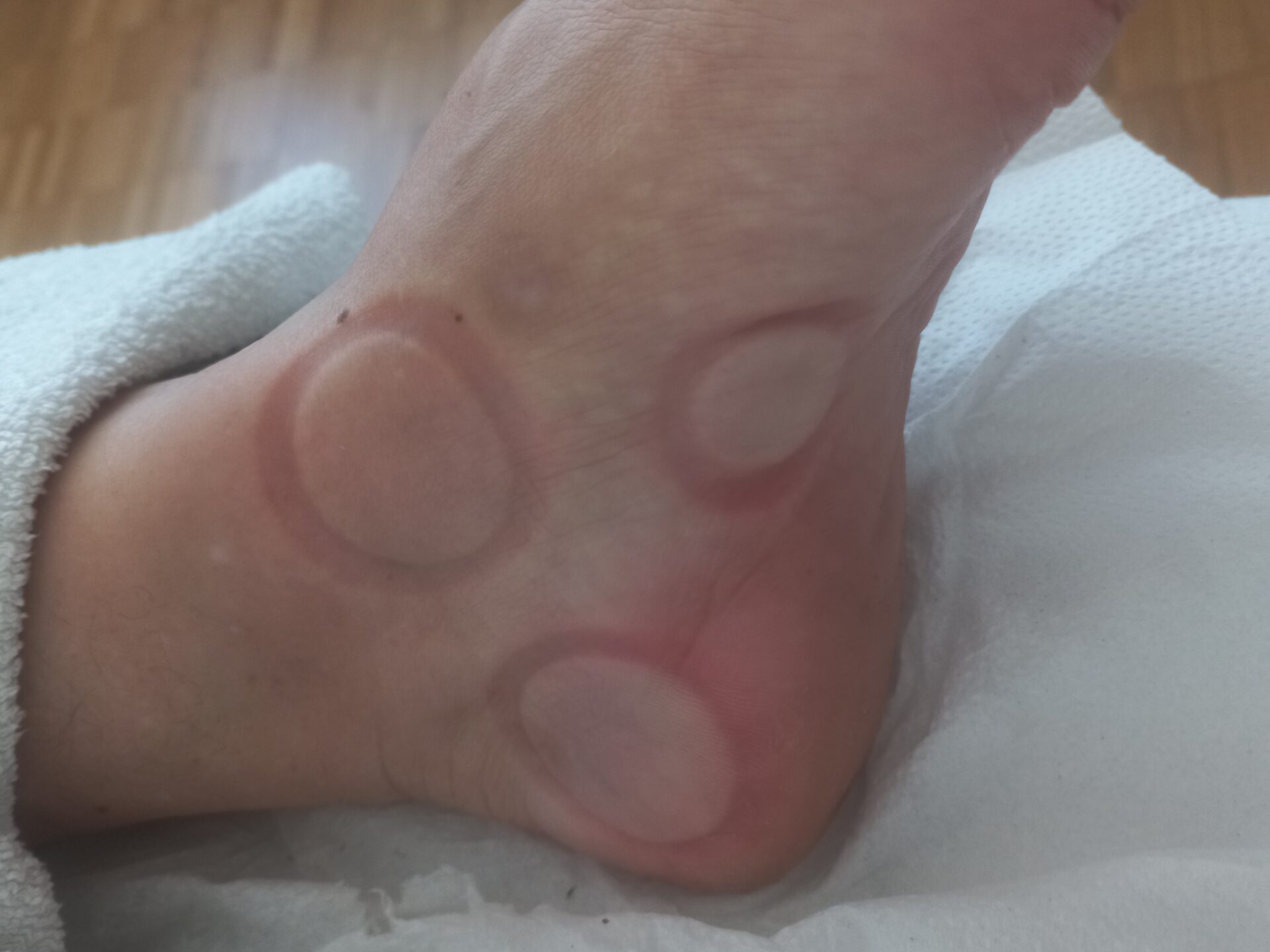 Dieses Bild zeigt Schröpfringe am Fuss